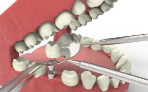 Natural-Looking Dental Implants in Palatine, IL
